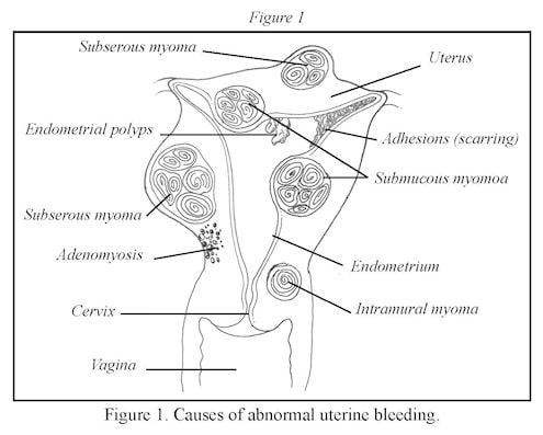 AbnormalUterineBleeding_Fig1.jpg