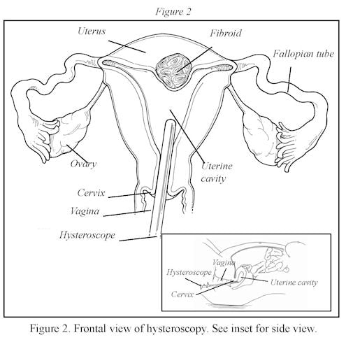 AbnormalUterineBleeding_Fig2.jpg