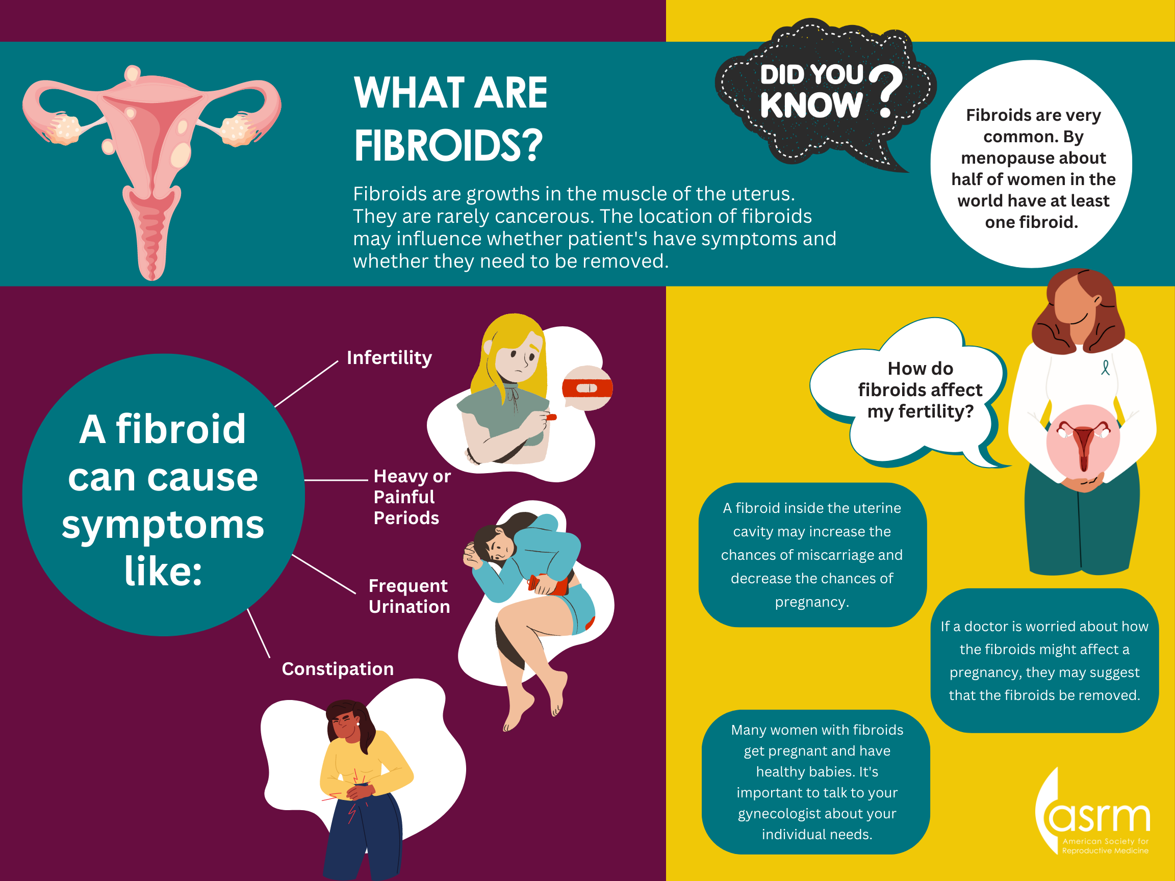 what-are-fibroids-reproductivefacts